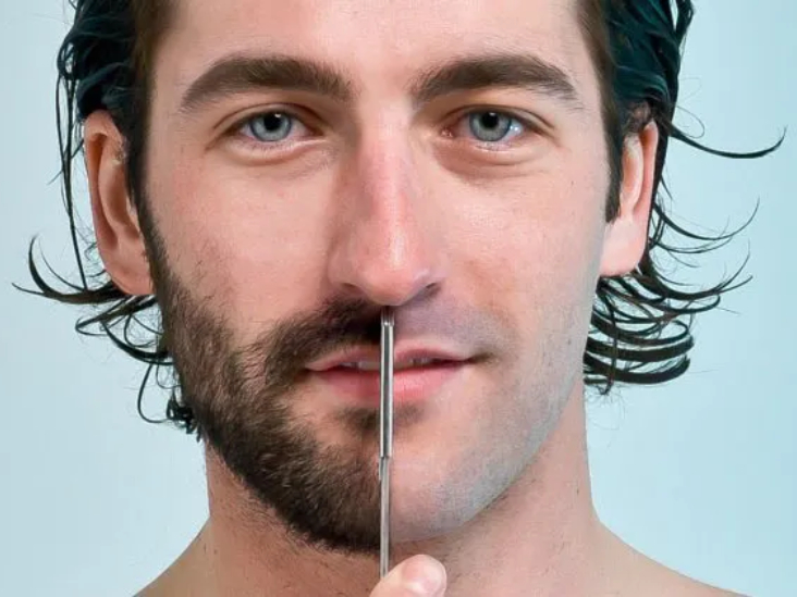 Beard Transplant
