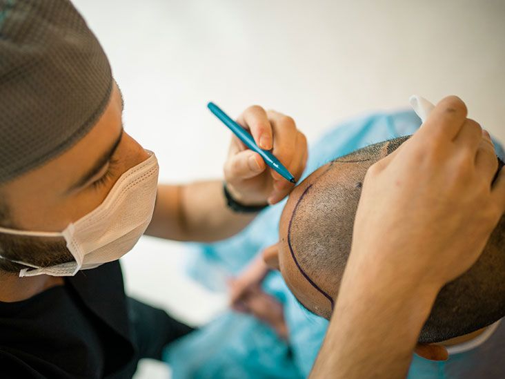 Hair Transplant