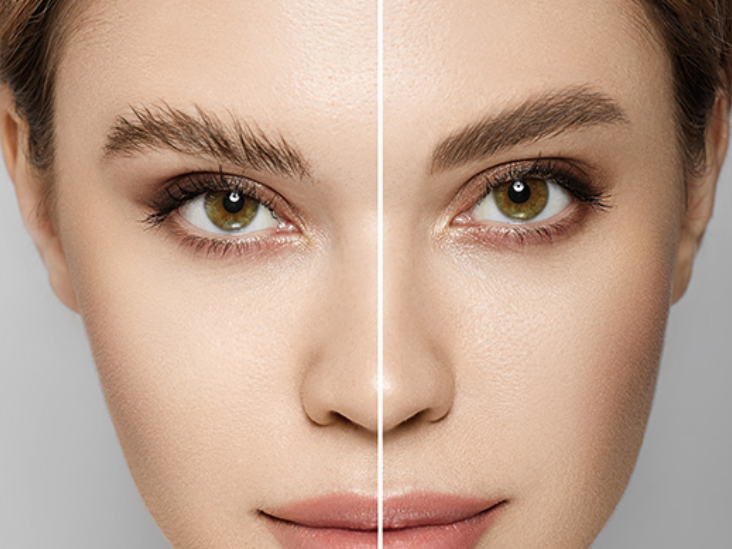 Eyebrow Transplant
