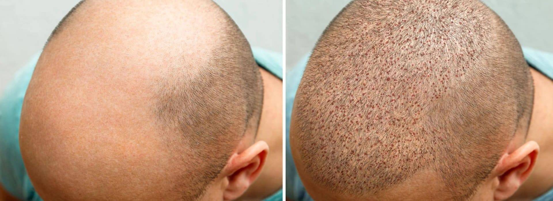 Hair Transplant Surgery